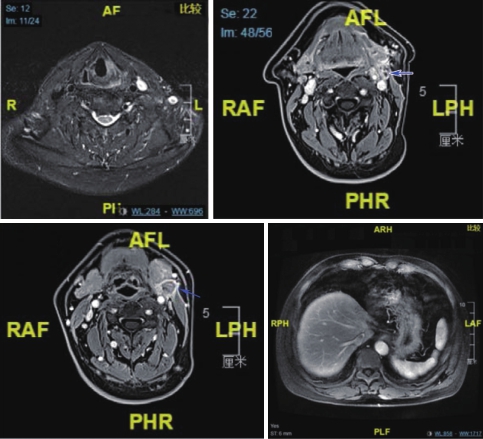 图3 喉MRI及腹部MRI（4疗程后）